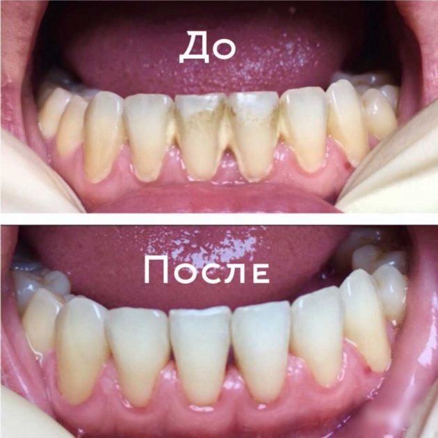 CHistka zubov do i posle foto 2 630x630